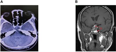 Case Report: High-Calorie Glucose Infusion and Tight Glycemic Control in Ameliorating Refractory Acidosis of Empagliflozin-Induced Euglycemic Diabetic Ketoacidosis